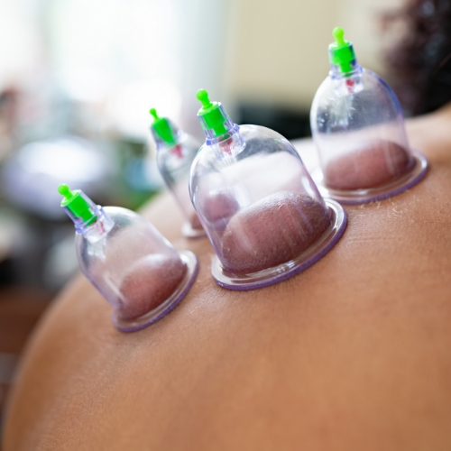 cupping-zenlife-physiotherapy-and-wellness-calgary-ab