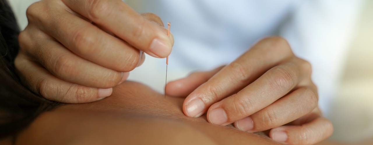 dry-needling-zenlife-physiotherapy-and-wellness-calgary-ab
