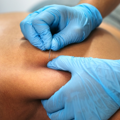 dry-needling-zenlife-physiotherapy-and-wellness-calgary-ab